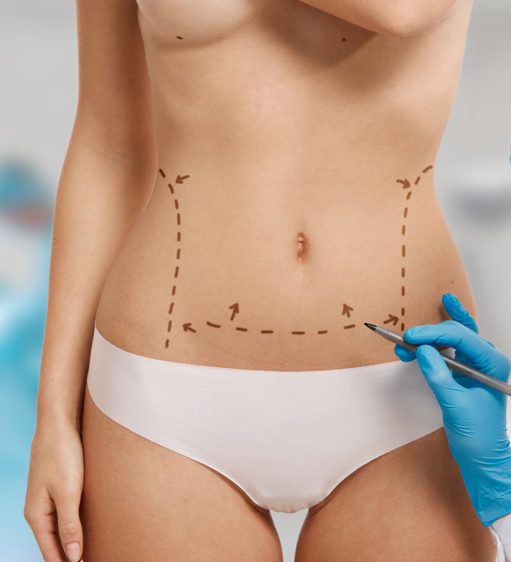 Plastic surgery doctor draw line on patient breast augmentation implant. Woman belly marked out for cosmetic surgery in surgery room interior